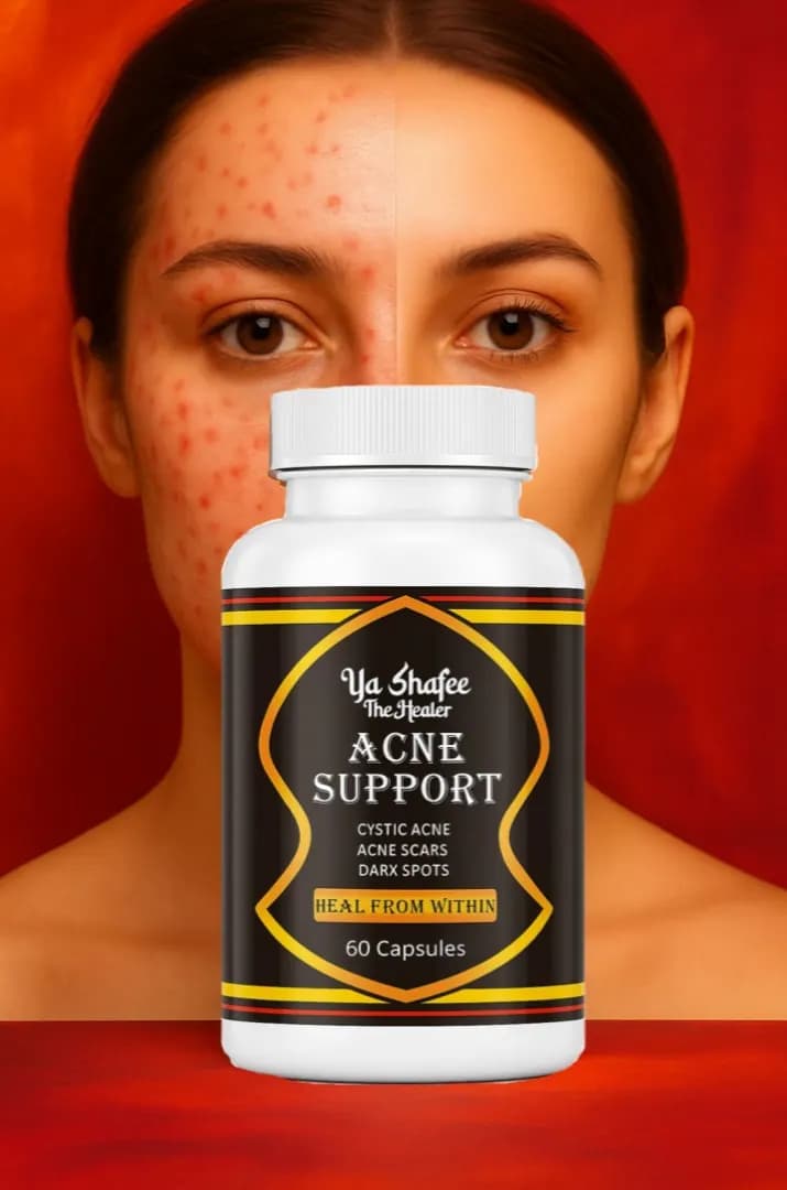 ACNE SUPPORT